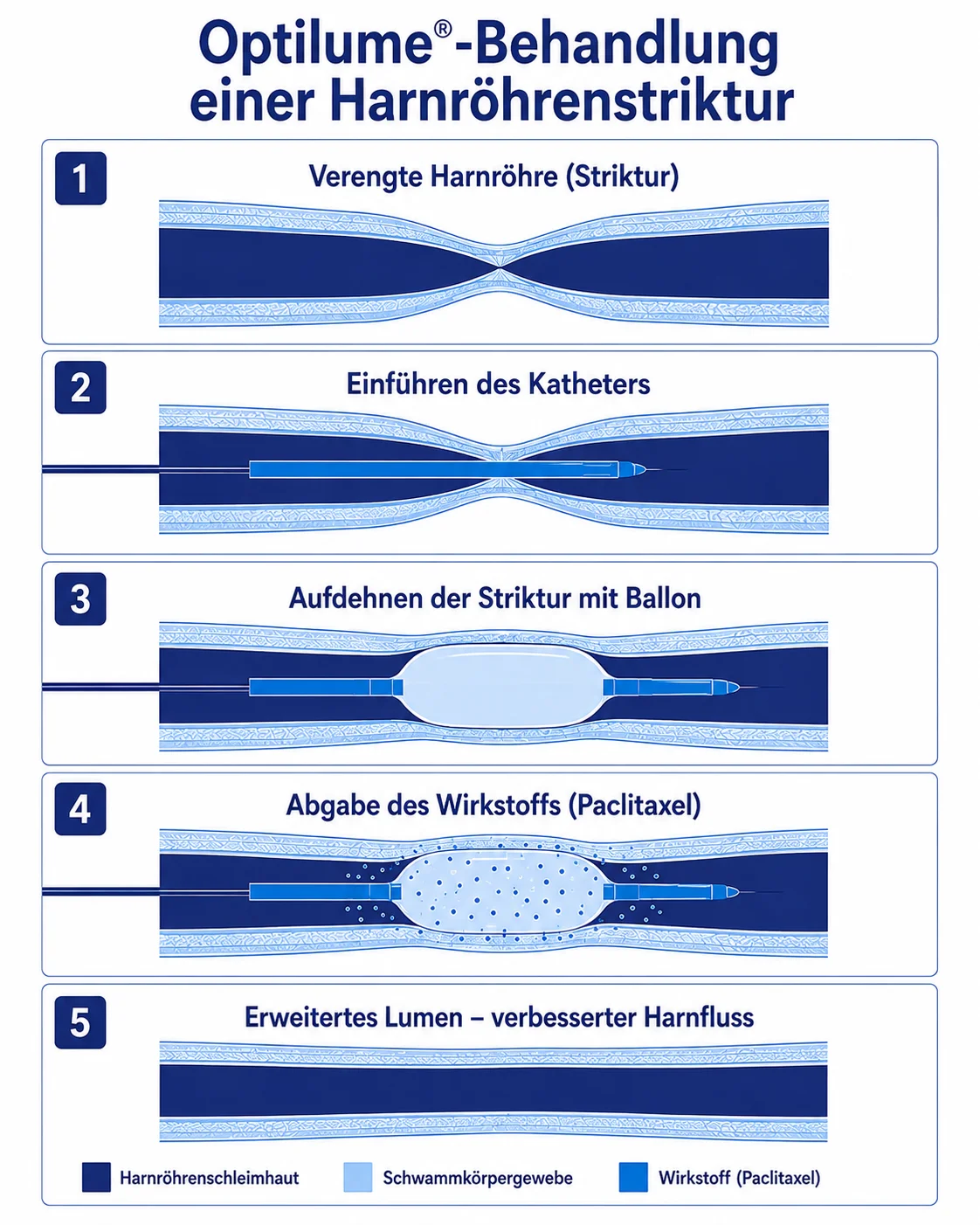 Optilume-Behandlung einer Harnröhrenverengung – Urocentrum West