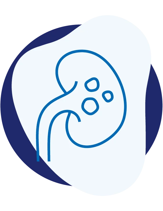Nierensteine – urologische Behandlung bei Urocentrum West